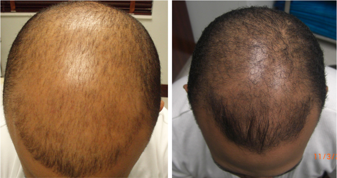 Carboxytherapy treatment for alopecia